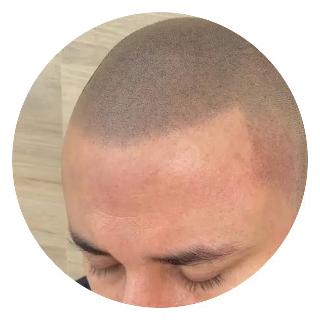 Tricopigmentación: La solución perfecta para la pérdida de cabello