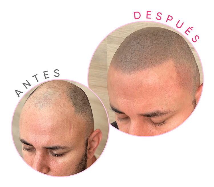 Tricopigmentación: Innovación en Micropigmentación Capilar