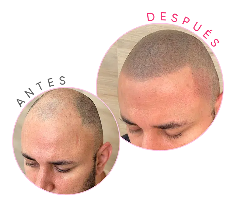 Tricopigmentación: Innovación en Micropigmentación Capilar