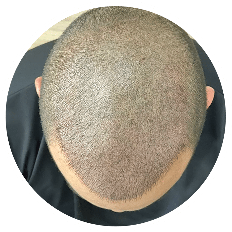 Tricopigmentación: La Solución Estética para la Pérdida de Cabello