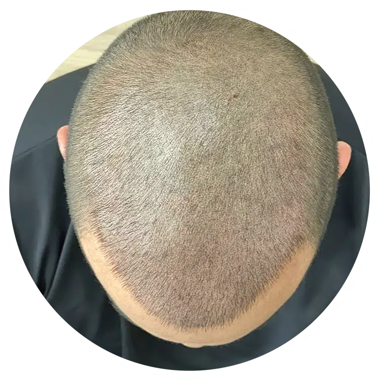 Tricopigmentación: La Solución Estética para la Pérdida de Cabello